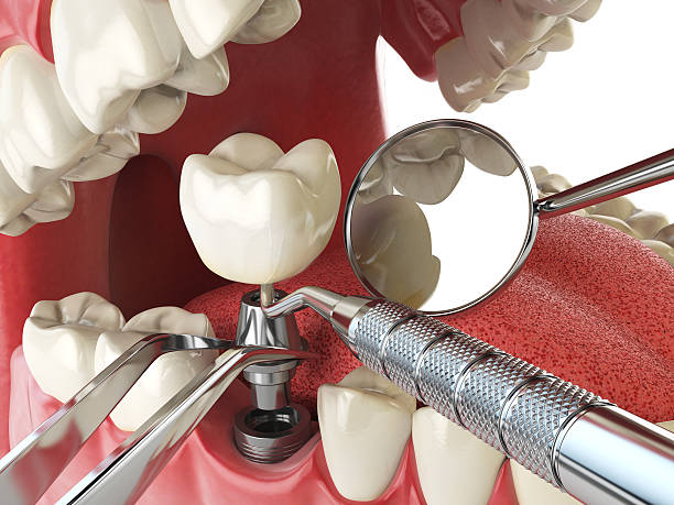Best Emergency Broken Tooth Repair in Stuart, FL